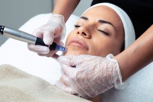 Microneedling or Micro Channeling Treatment